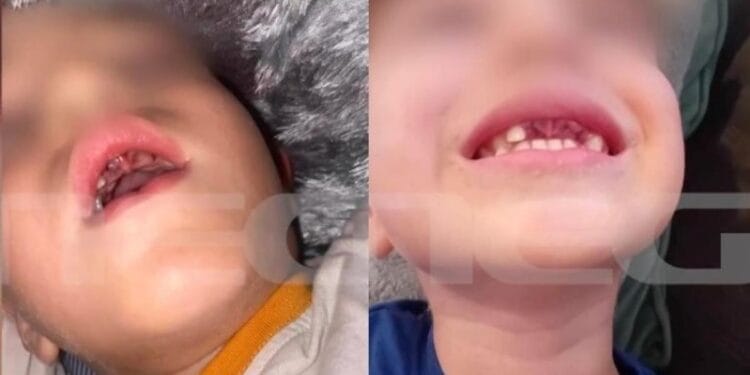 Νέο περιστατικό bullying με παιδιά: 5χρονα χτύπησαν 4χρονο συμμαθητή τους με αυτισμό